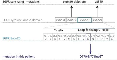 Case Report: Osimertinib Followed by Osimertinib Plus Bevacizumab, Personalized Treatment Strategy for a Lung Cancer Patient With a Novel EGFR Exon 20 Insertion D770_N771insGT and Multiple Brain Metastases